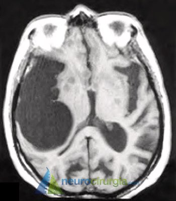 Neurocisticercose Neurocirurgia