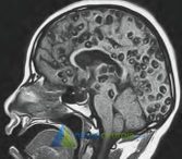 Neurocisticercose Neurocirurgia