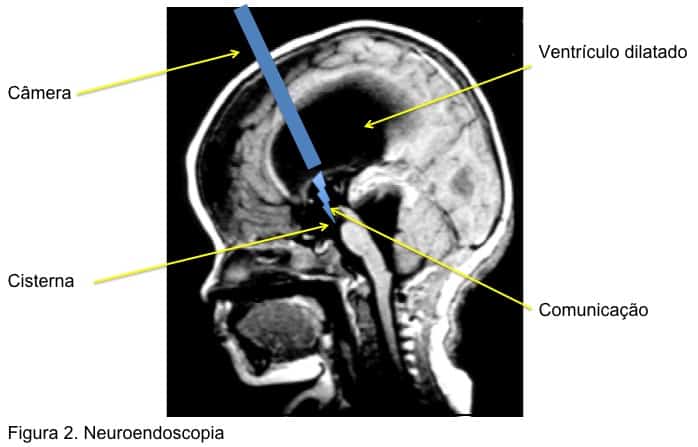 Hidrocefalia Neurocirurgia 4717