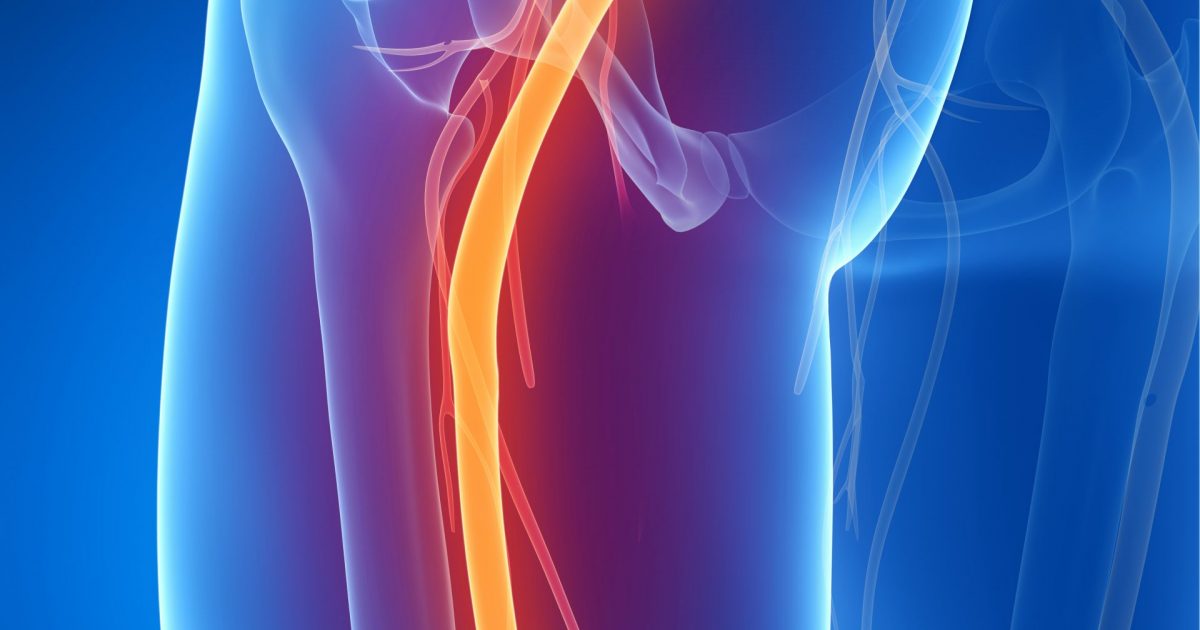 inflamaia nervului sciatic varicoza)